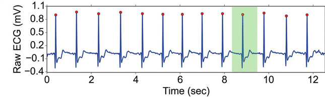 Raw ECG waveform showing repeating heartbeats over twelve seconds